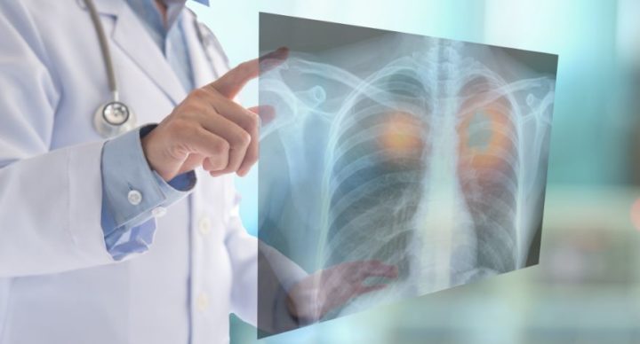 Câncer de pulmão provoca mais de 28 mil mortes no Brasil por ano